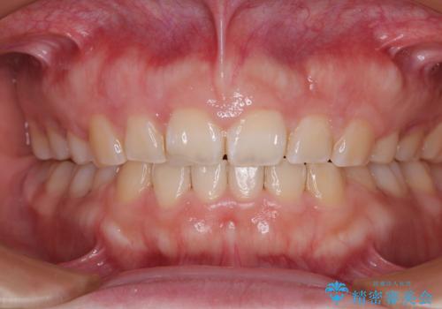 口元の突出感を治したい ワイヤー装置を用いた抜歯矯正の治療後