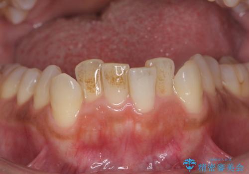 着色を綺麗にの症例 治療前