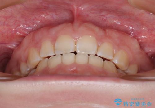 口元の突出感を治したい ワイヤー装置を用いた抜歯矯正の治療後