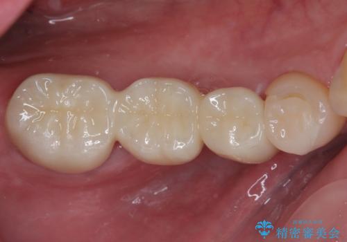 詰め物が割れた フルジルコニアクラウンの治療前