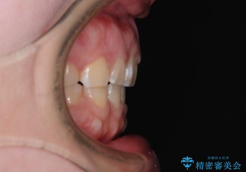 口元の突出感を治したい ワイヤー装置を用いた抜歯矯正の治療後