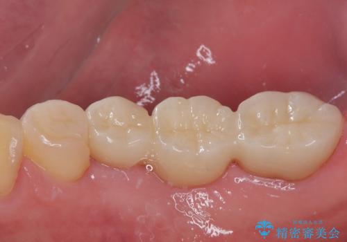 詰め物が割れた フルジルコニアクラウンの治療前