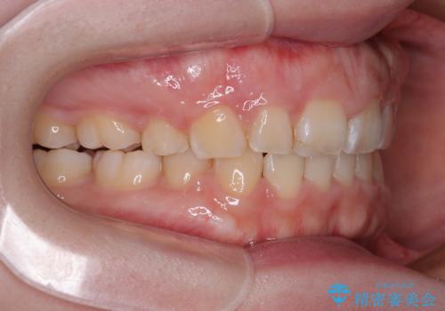 口元の突出感を治したい ワイヤー装置を用いた抜歯矯正の治療後