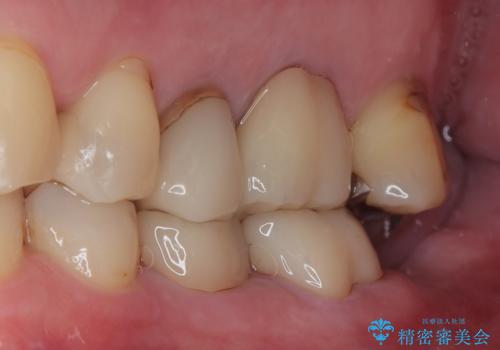 銀歯が取れたのでやり替えたい　セラミックインレー修復の治療後