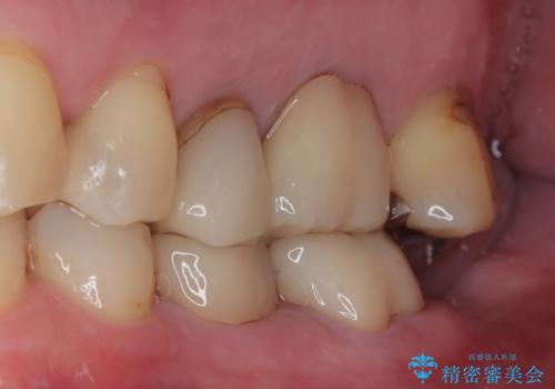銀歯が取れたのでやり替えたい セラミックインレー修復の治療後