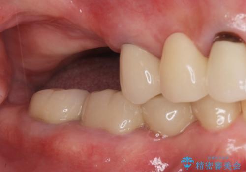 70代女性 状態の悪い歯を抜歯して、奥歯をブリッジにの症例 治療後