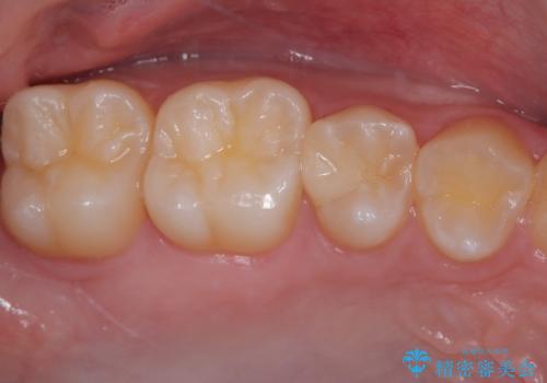 歯間部の自分では気づきにくい虫歯　セラミックインレー修復