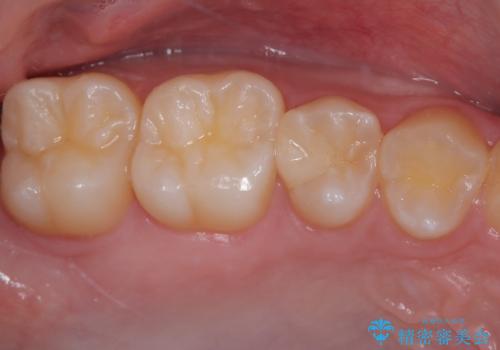 歯間部の自分では気づきにくい虫歯 セラミックインレー修復の症例 治療後