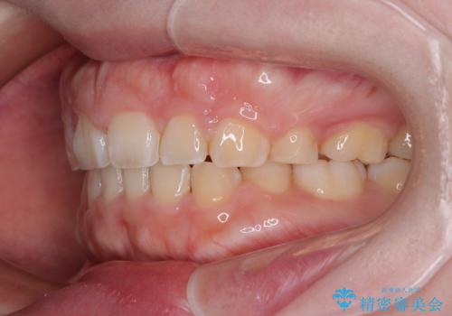 口元の突出感を治したい ワイヤー装置を用いた抜歯矯正の治療後