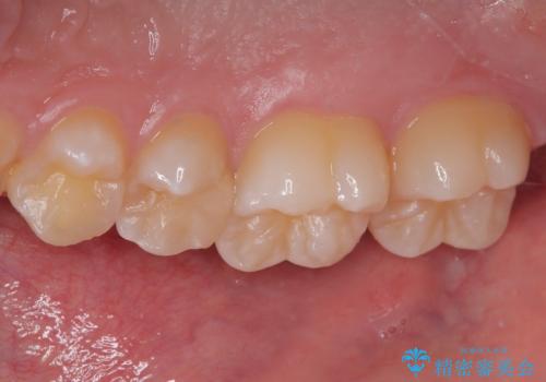 歯間部の自分では気づきにくい虫歯　セラミックインレー修復の治療後