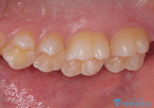 歯間部の自分では気づきにくい虫歯 セラミックインレー修復の治療後