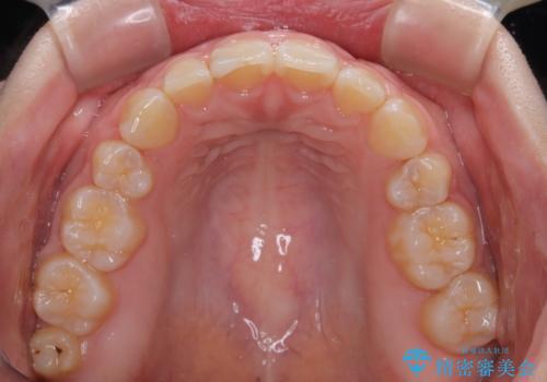 口元の突出感を治したい ワイヤー装置を用いた抜歯矯正の治療後