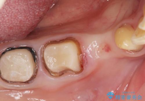 70代女性 状態の悪い歯を抜歯して、奥歯をブリッジにの治療中