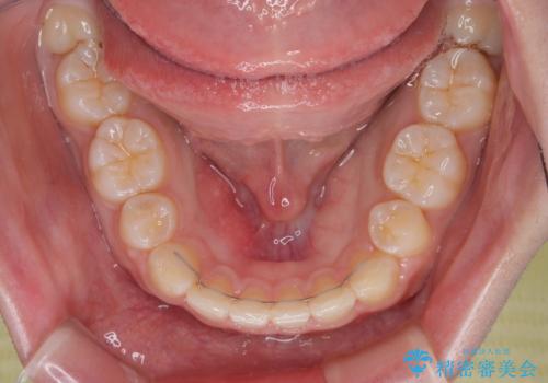 口元の突出感を治したい ワイヤー装置を用いた抜歯矯正の治療後