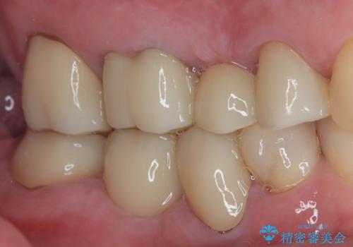 詰め物が割れた フルジルコニアクラウンの治療前