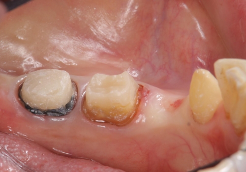 70代女性 状態の悪い歯を抜歯して、奥歯をブリッジにの治療中