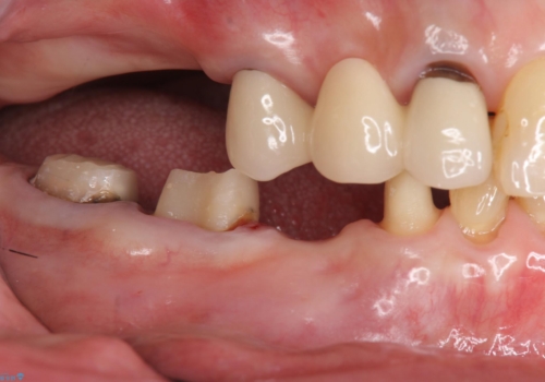 70代女性 状態の悪い歯を抜歯して、奥歯をブリッジにの治療中