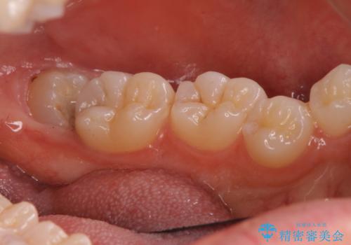 斜めに生えてきている親知らずを抜きたいの治療前