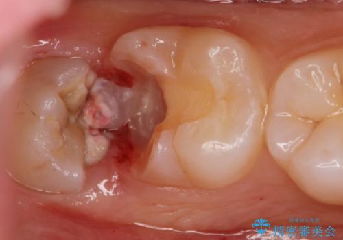斜めに生えてきている親知らずを抜きたいの治療中