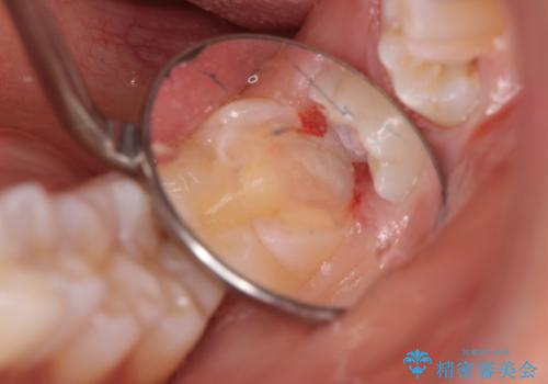 斜めに生えてきている親知らずを抜きたいの治療中