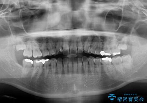 マウスピース矯正が煩わしい　ワイヤー装置での非抜歯矯正の治療前