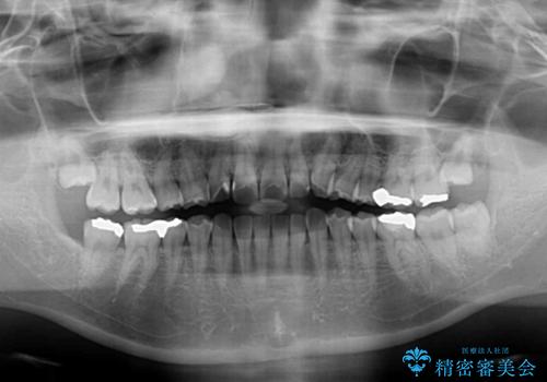 マウスピース矯正が煩わしい ワイヤー装置での非抜歯矯正の治療前