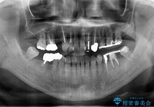 虫歯・噛み合わせ・インプラント、全顎総合治療の治療前