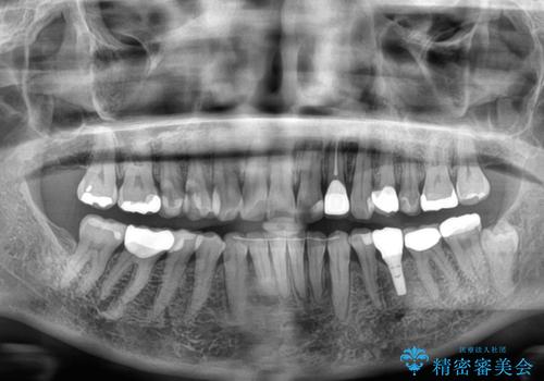 むし歯と前歯のデコボコを治したい　インビザラインを使用した総合歯科治療の治療後