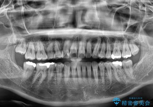 マウスピース矯正が煩わしい　ワイヤー装置での非抜歯矯正の治療後
