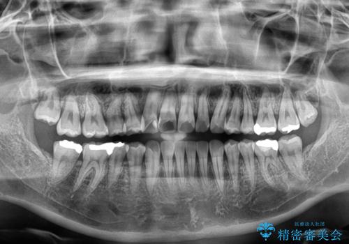 マウスピース矯正が煩わしい ワイヤー装置での非抜歯矯正の治療後