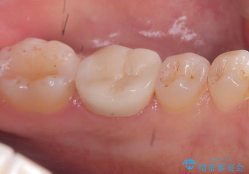 【セラミッククラウン】歯がポロポロ欠けたの治療後