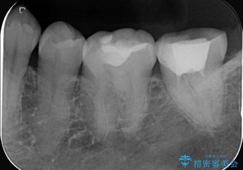 他院の根管治療後の違和感を解消!精密な根管治療で健康な歯を守るの治療前