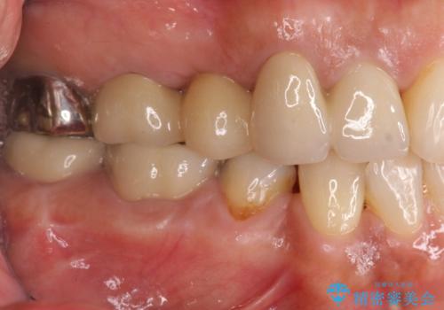 歯槽堤保存を併用し清掃性を高めたブリッジ治療の治療後