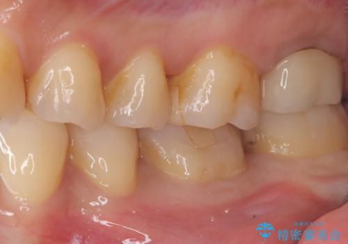 【セラミッククラウン】歯がポロポロ欠けたの治療前