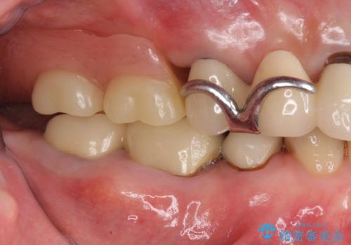 70代女性 状態の悪い歯を抜歯して、奥歯をブリッジにの治療前