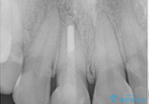 根管治療と並行して矯正を マウスピース治療の治療前