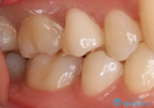 奥歯の保険の詰め物を自費のものに変えたいの治療前