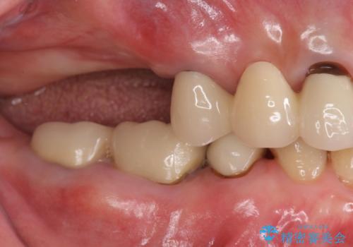 70代女性 状態の悪い歯を抜歯して、奥歯をブリッジにの症例 治療前