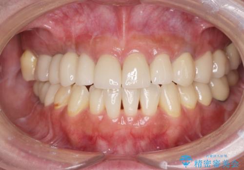 虫歯・噛み合わせ・インプラント、全顎総合治療の治療後