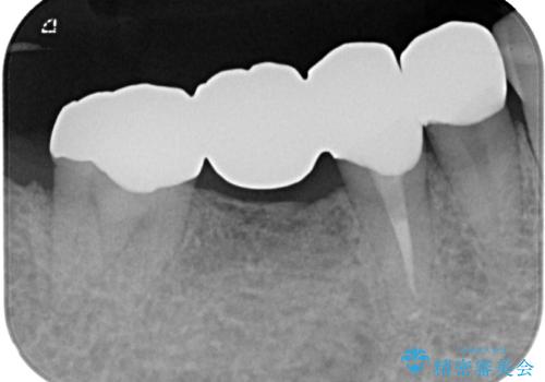 詰め物が割れた フルジルコニアクラウンの治療後