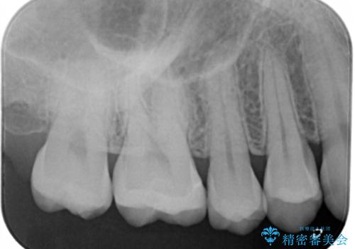 奥歯の保険の詰め物を自費のものに変えたいの治療後