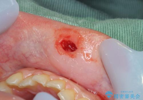 粘液嚢胞の切除の治療中