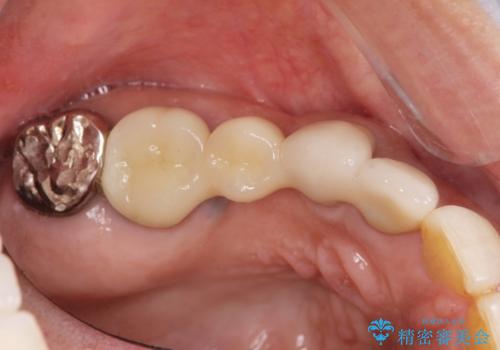 歯槽堤保存を併用し清掃性を高めたブリッジ治療の治療後