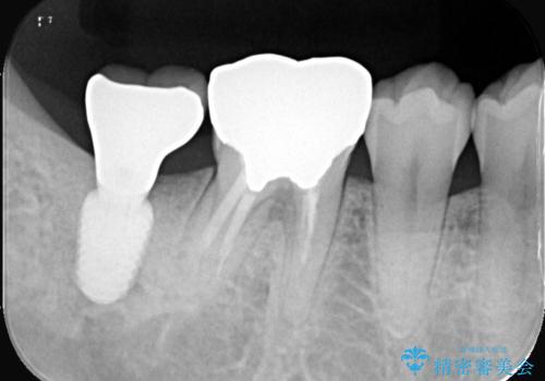 歯のインプラント治療|1回の手術で負担を軽減し、自然な噛み心地を再現の治療後