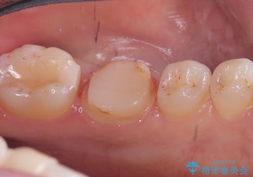 【セラミッククラウン】歯がポロポロ欠けたの治療中