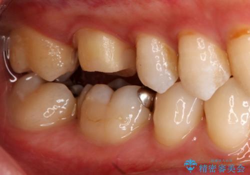 銀歯を白くしたい フルジルコニアクラウンとセラミックインレーの治療中