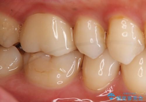 銀歯を白くしたい フルジルコニアクラウンとセラミックインレーの治療後