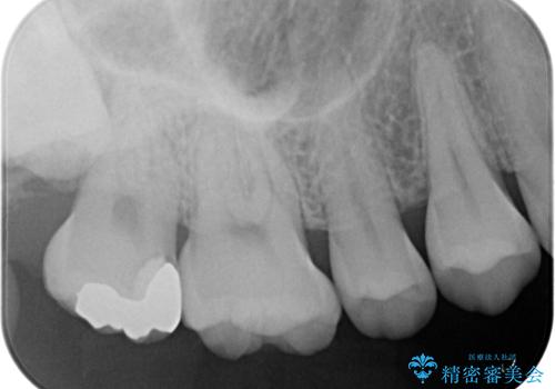 はじめて虫歯ができた　ゴールドインレー修復の治療後