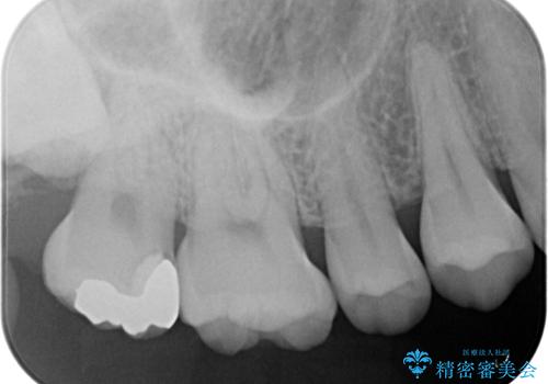 はじめて虫歯ができた ゴールドインレー修復の治療後
