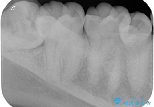 斜めに生えてきている親知らずを抜きたいの治療前